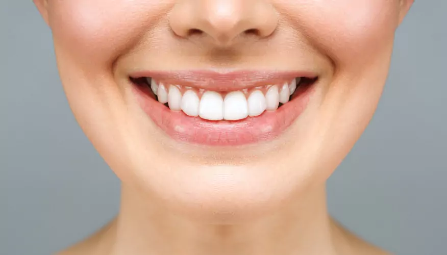 Smile 1 After