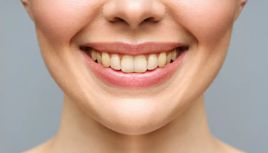 Smile 1 Before
